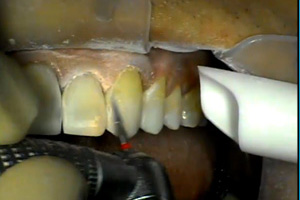 Freehand Composite Bonding Part 1 Dental CE Video Course by Corky Willhite, DDS