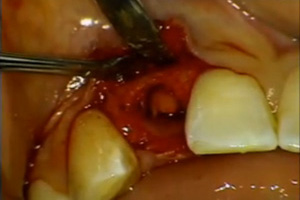 Single tooth replacement with immediate temporization in the aesthetic zone Dental CE Video Course by Michael Skinner, DDS