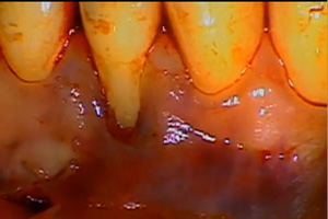Connective Tissue Grafting Dental CE Video Course by Michael Skinner, DDS