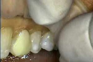 Prepless Veneers: Smile design and seat. Dental CE Video Course by Dr. David Hornbrook, DDS, FAACD
