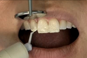 Indirect porcelain veneers Part I: The mock-up Dental CE Video Course by Dr. John Weston, DDS, FAACD