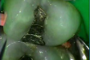 Direct Composites: Rational and Methodology Dental CE Video Course by Gary Alex, DMD