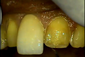 Artistically Placing Laminate Veneers Dental CE Video Course by Larry Rosenthal, DDS