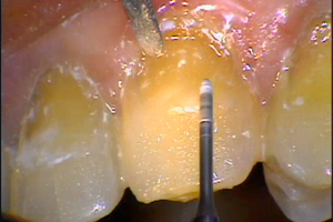 Using Composite Resin in Aesthetic Restorative Dentistry Dental CE Video Course by Buddy Mopper, DDS