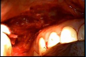 Lip Travel Reduction Dental CE Video Course by Michael Skinner, DDS