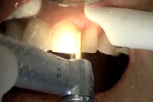 Indirect porcelain veneers Part II: The prep Dental CE Video Course by Dr. John Weston, DDS, FAACD